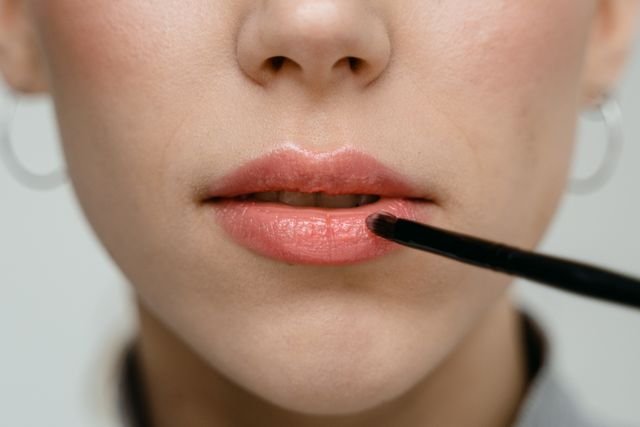 After Lip Fillers — Volume & Shape